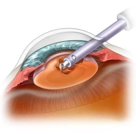 Clinical image — Cataract surgery.