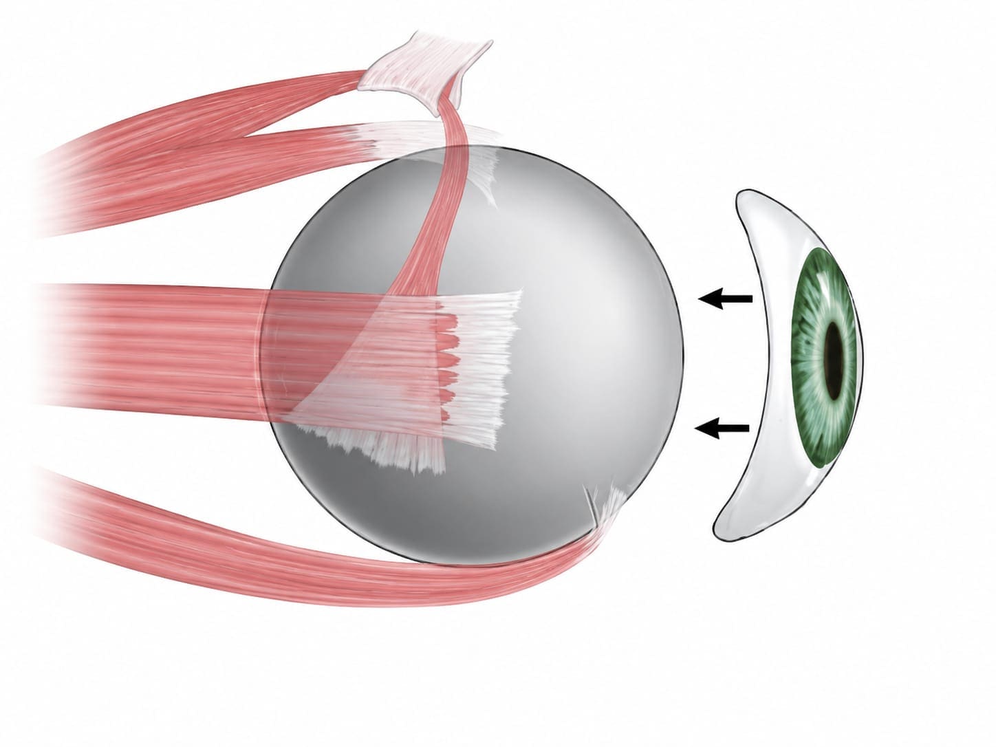 Clinical image — Enucleation.
