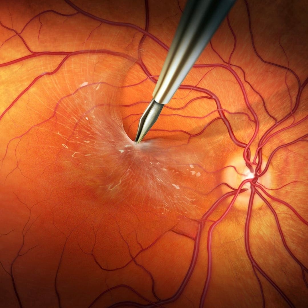 Clinical image — Epiretinal membrane surgery.