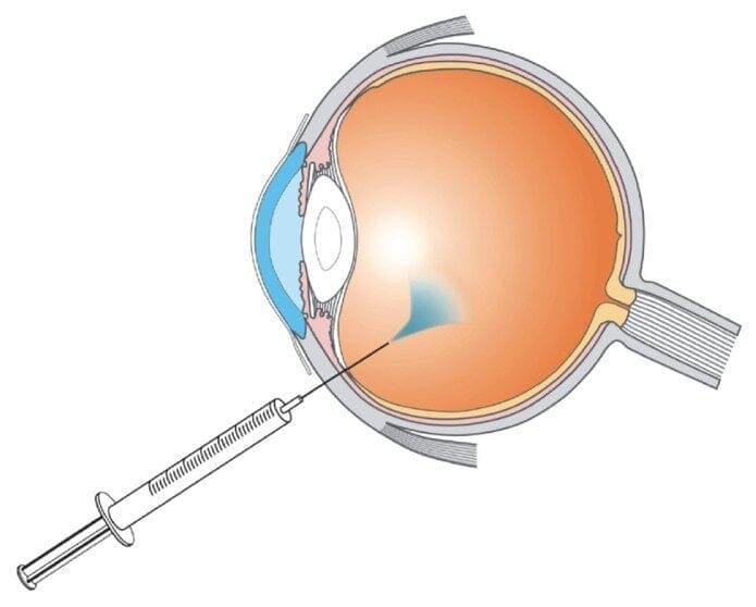 Clinical image — Intravitreal injections.