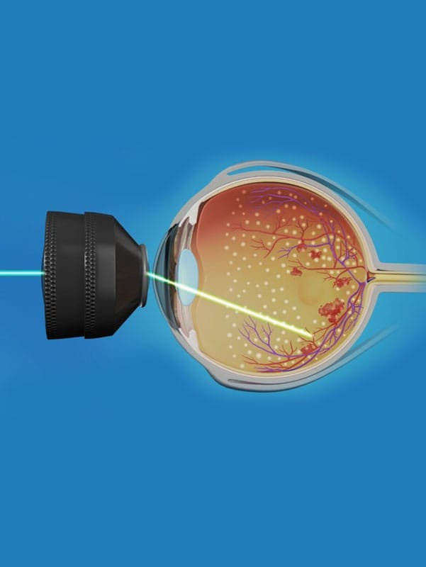 Clinical image — Laser retinopexy.