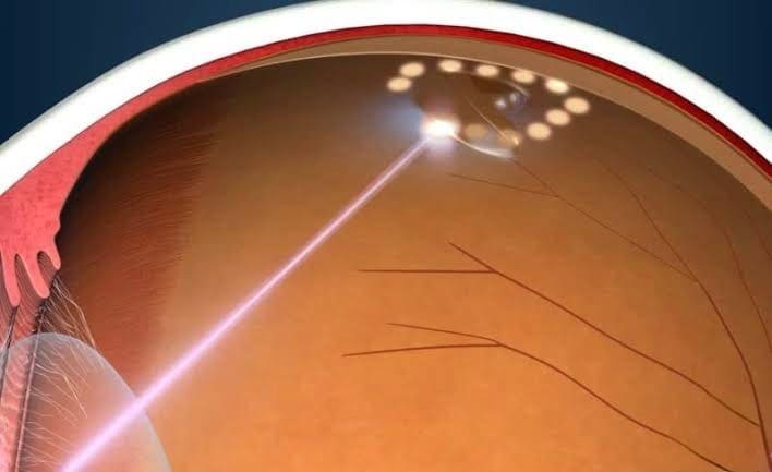 Clinical image — Laser retinopexy.