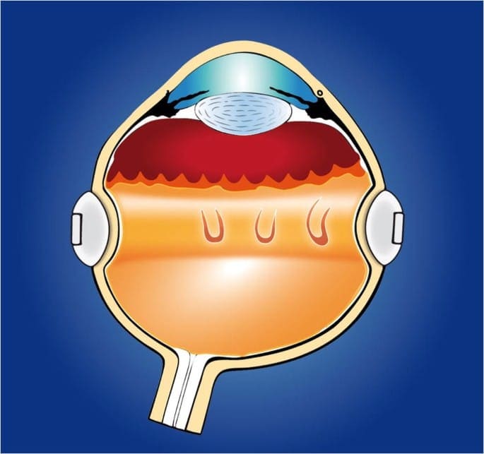 Clinical image — Scleral buckling.