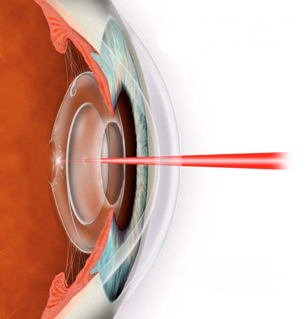 Clinical image — YAG laser capsulotomy.